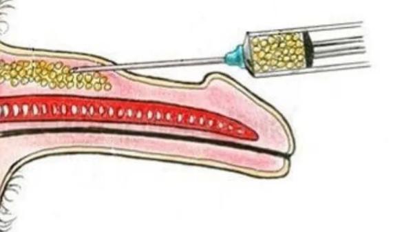 Ameliyatsız Penis Büyütme Yöntemleri