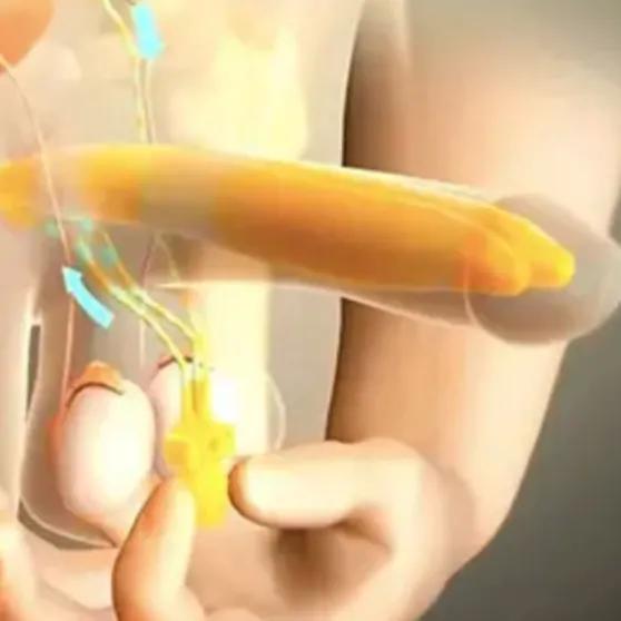 Chirurgie der Penisprothese (Happiness Stick)