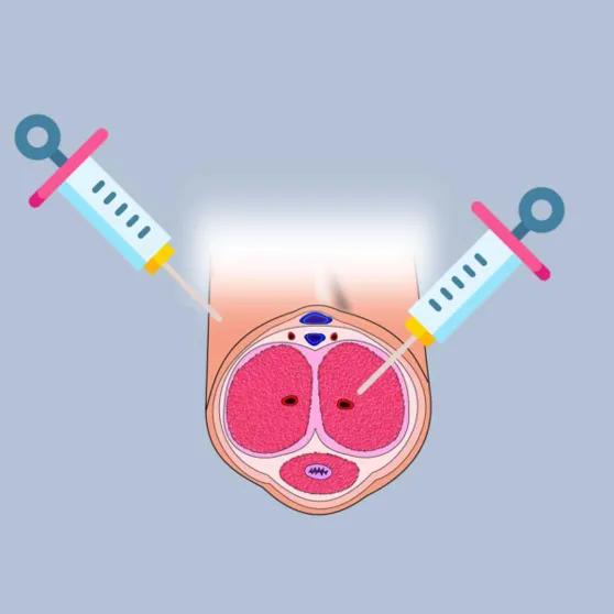 P-Shot (PRP)-Behandlung bei erektiler Dysfunktion